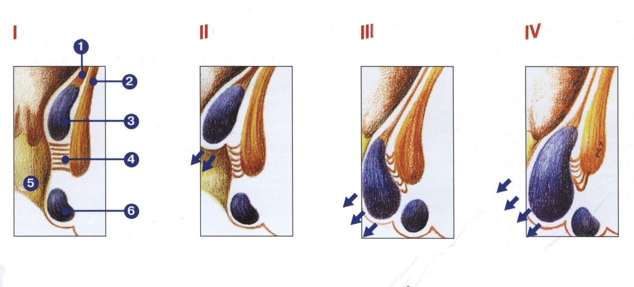 Στάδια ανάπτυξης αιμορροΐδων