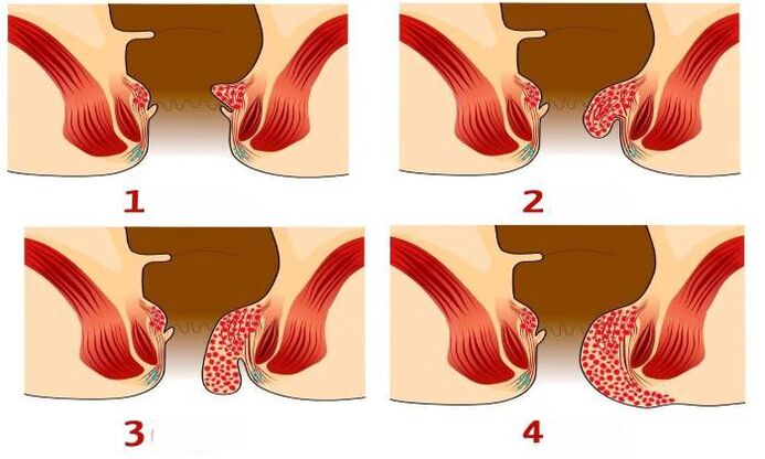 πώς μοιάζουν οι αιμορροΐδες σε διαφορετικά στάδια